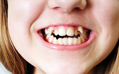 Bad teeth