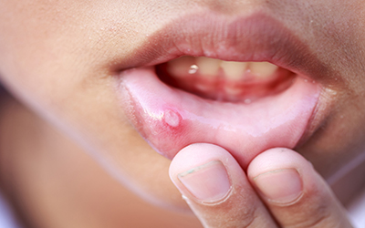 An image of a canker sore 