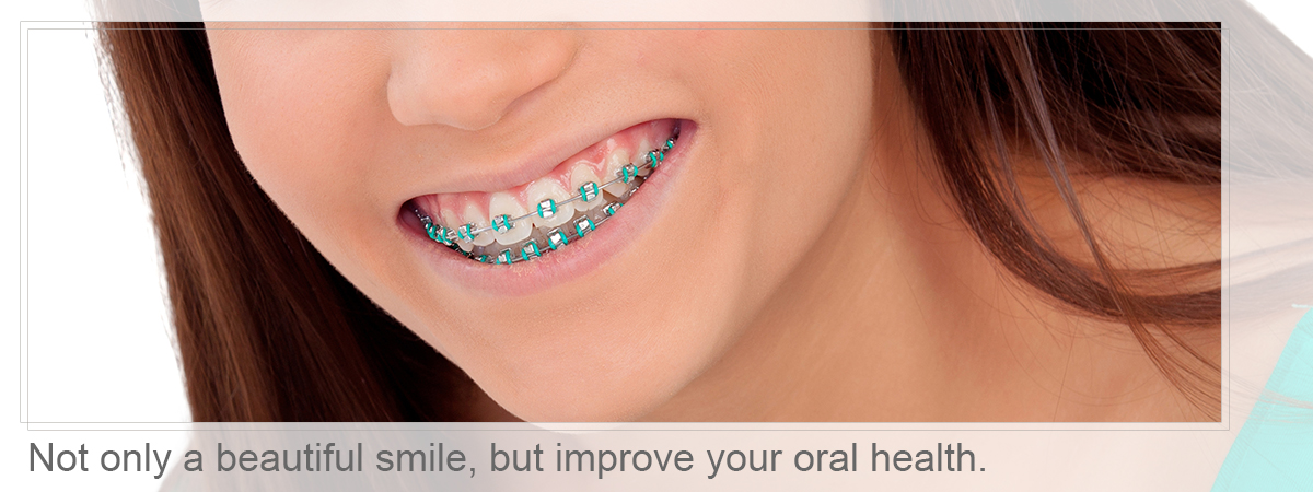 Close-up of braces, Not only a beautiful smile, but improve your oral health.