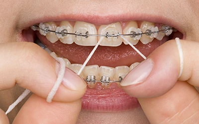 A person flossing with braces