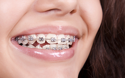 A woman smiling with braces